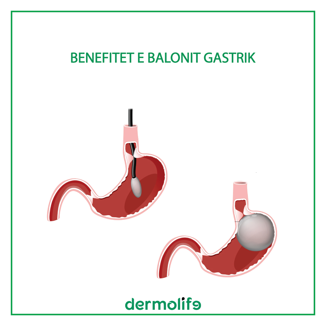 Benefitet e Balonit Gastrik