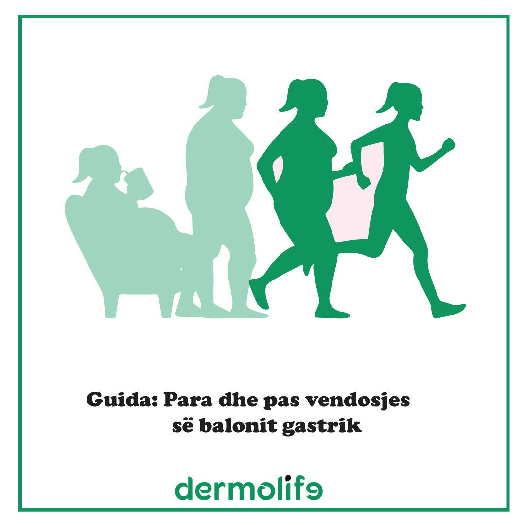 Guida e vendosjes se Balonit Gastrik