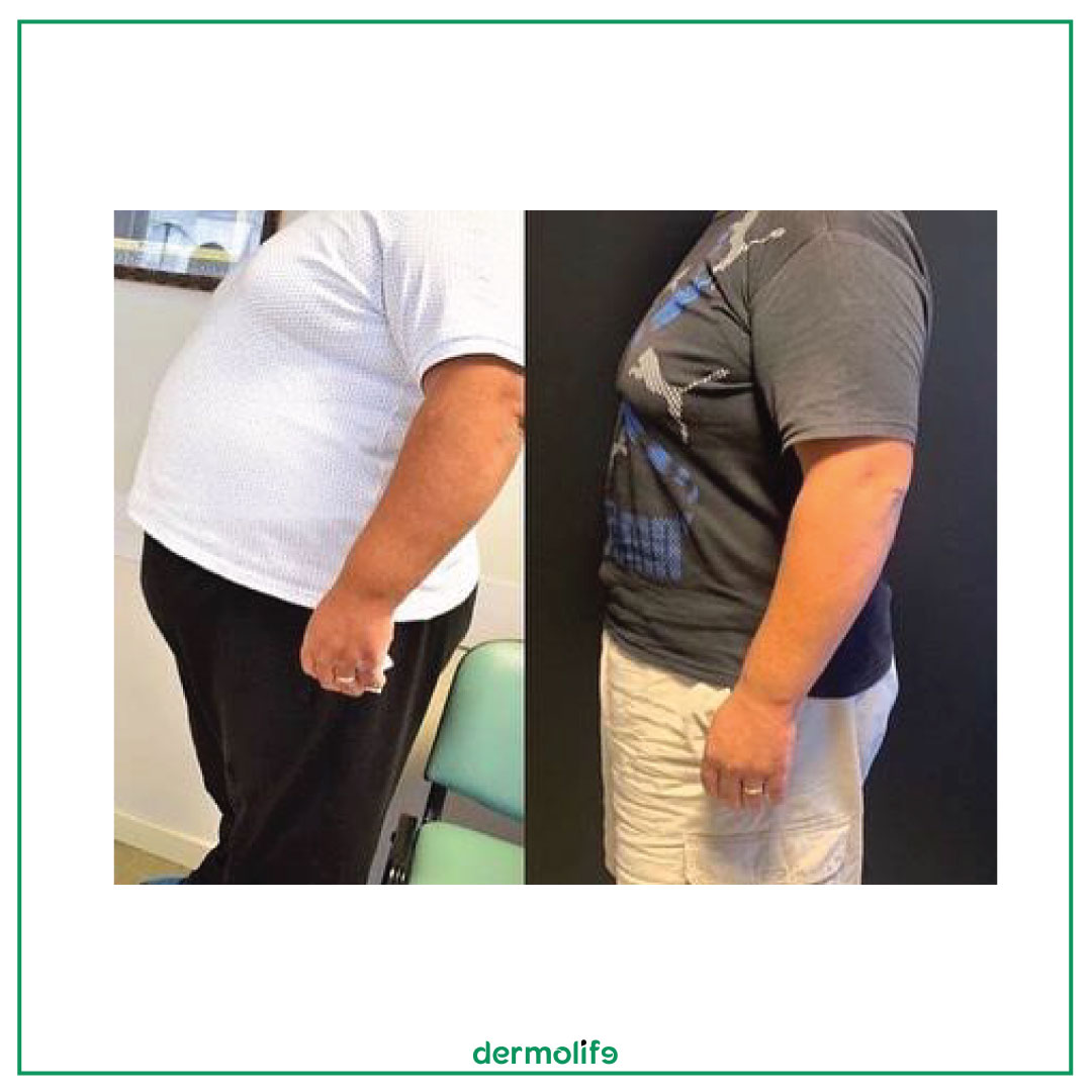 Deshmi Pacienti Baloni Gastrik