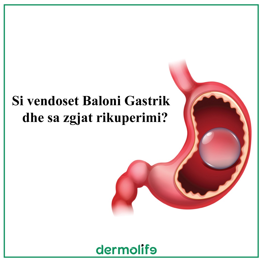 Deshmi Pacienti Baloni Gastrik